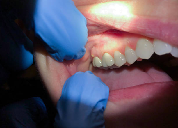 Best Emergency Wisdom Teeth Removal in Arcade, GA