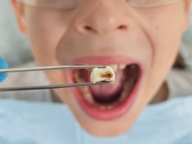 Best Emergency Treatment for Dental Infections or Abscesses in Arcade, GA